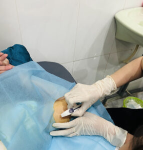 cấy que tránh thai